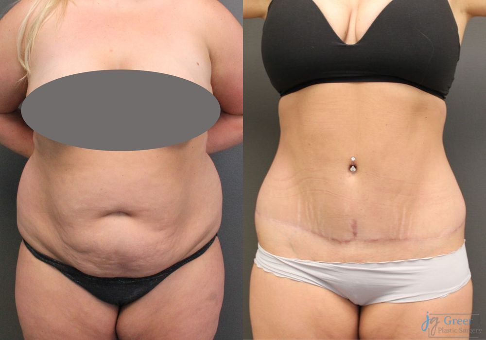 Abdominoplasty - Case 2293