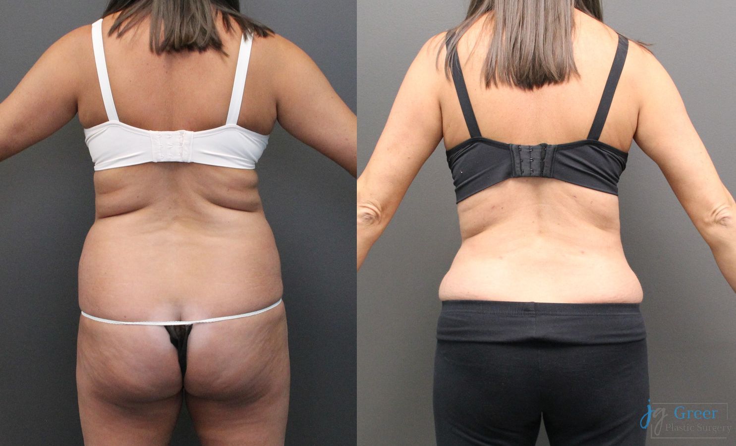 Before and after Abdominoplasty case 19845 - Angle 3
