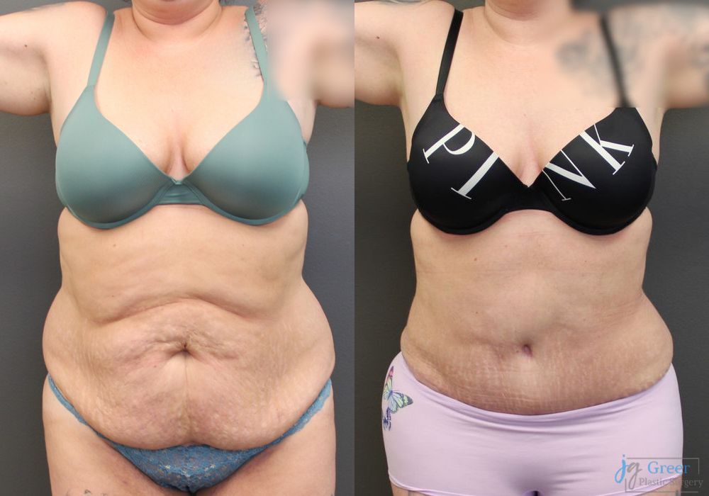 Abdominoplasty - Case 2294