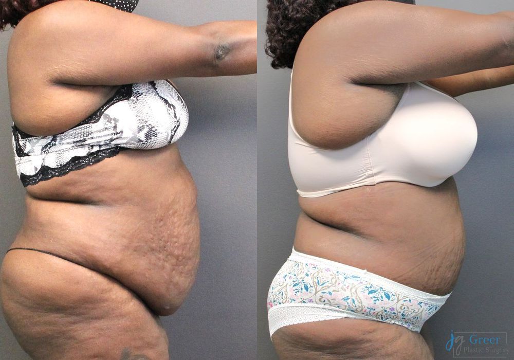 Abdominoplasty - Thumbnail 2