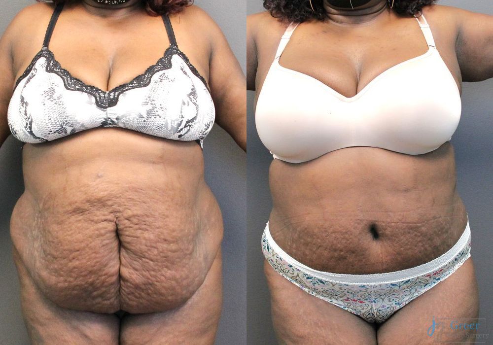 Abdominoplasty - Case 2298