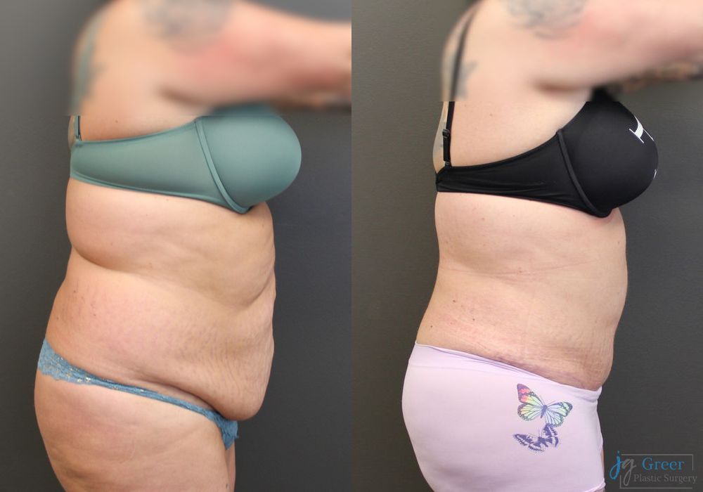 Abdominoplasty - Thumbnail 2