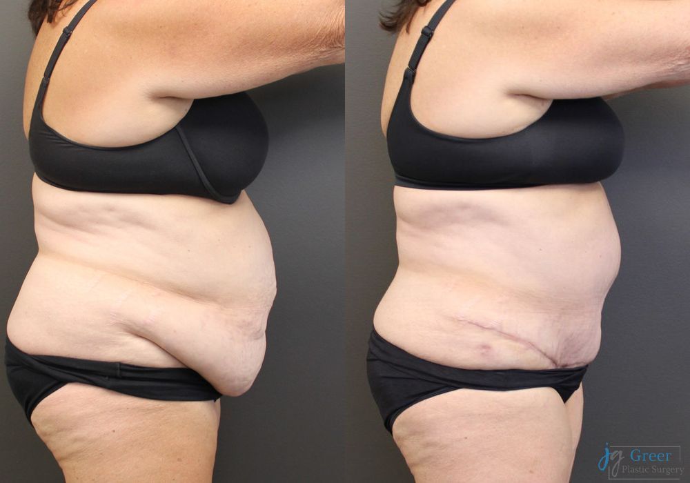 Abdominoplasty - Thumbnail 2