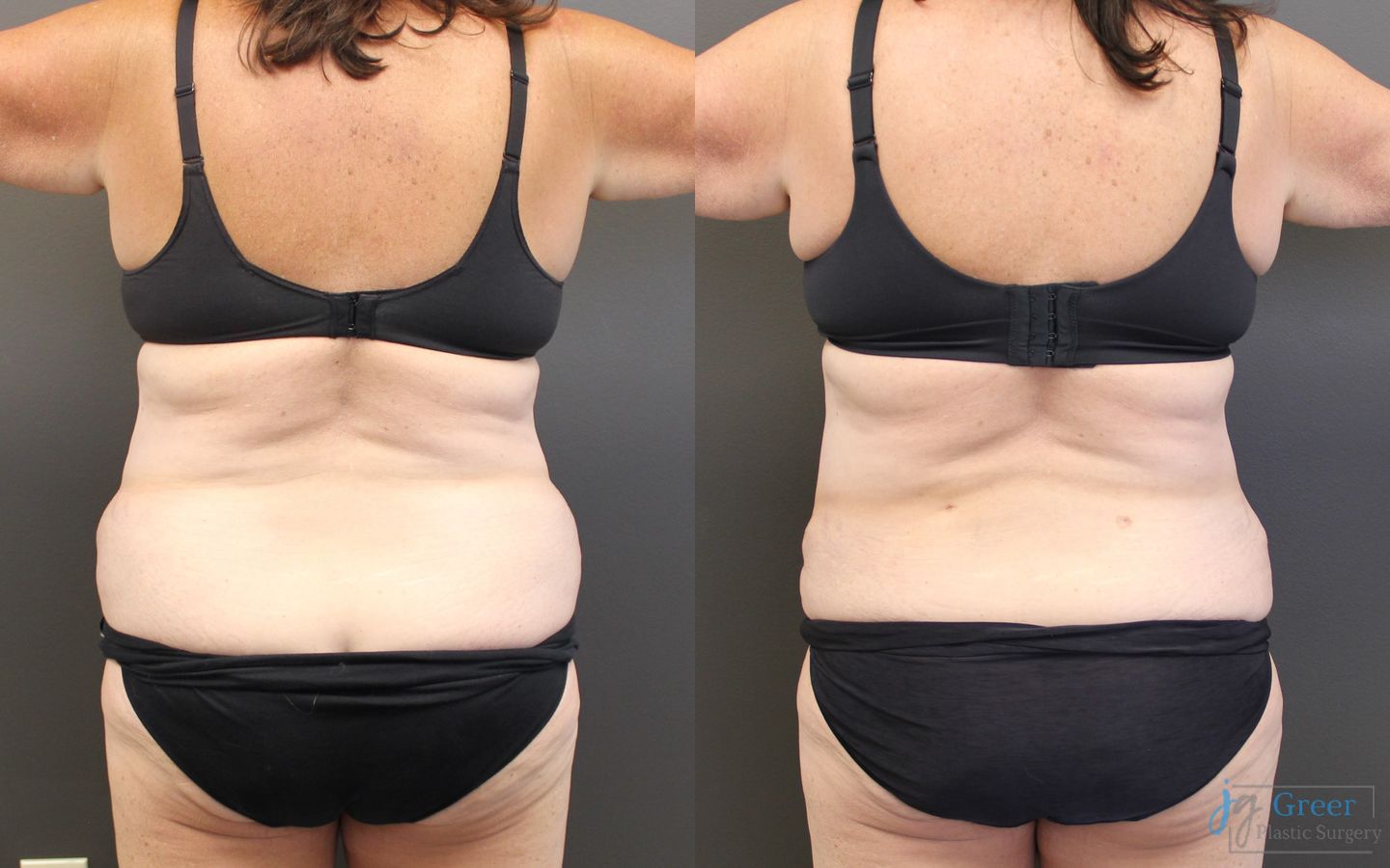 Before and after Abdominoplasty case 19840 - Angle 3