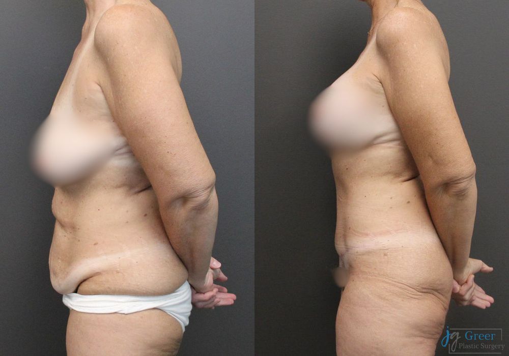 Abdominoplasty - Thumbnail 2