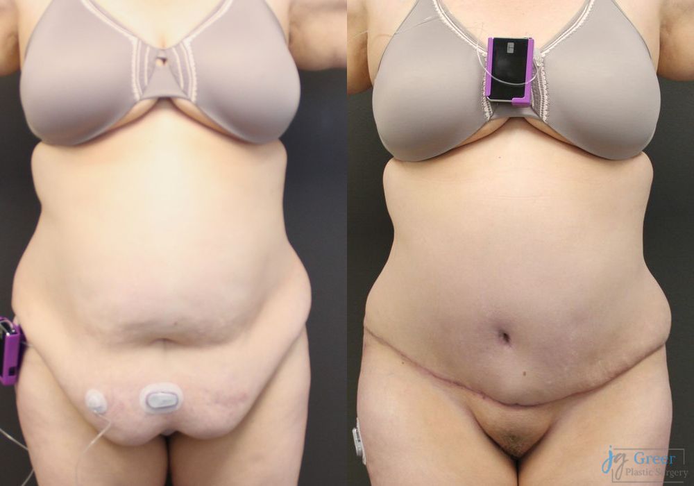 Abdominoplasty - Case 2291