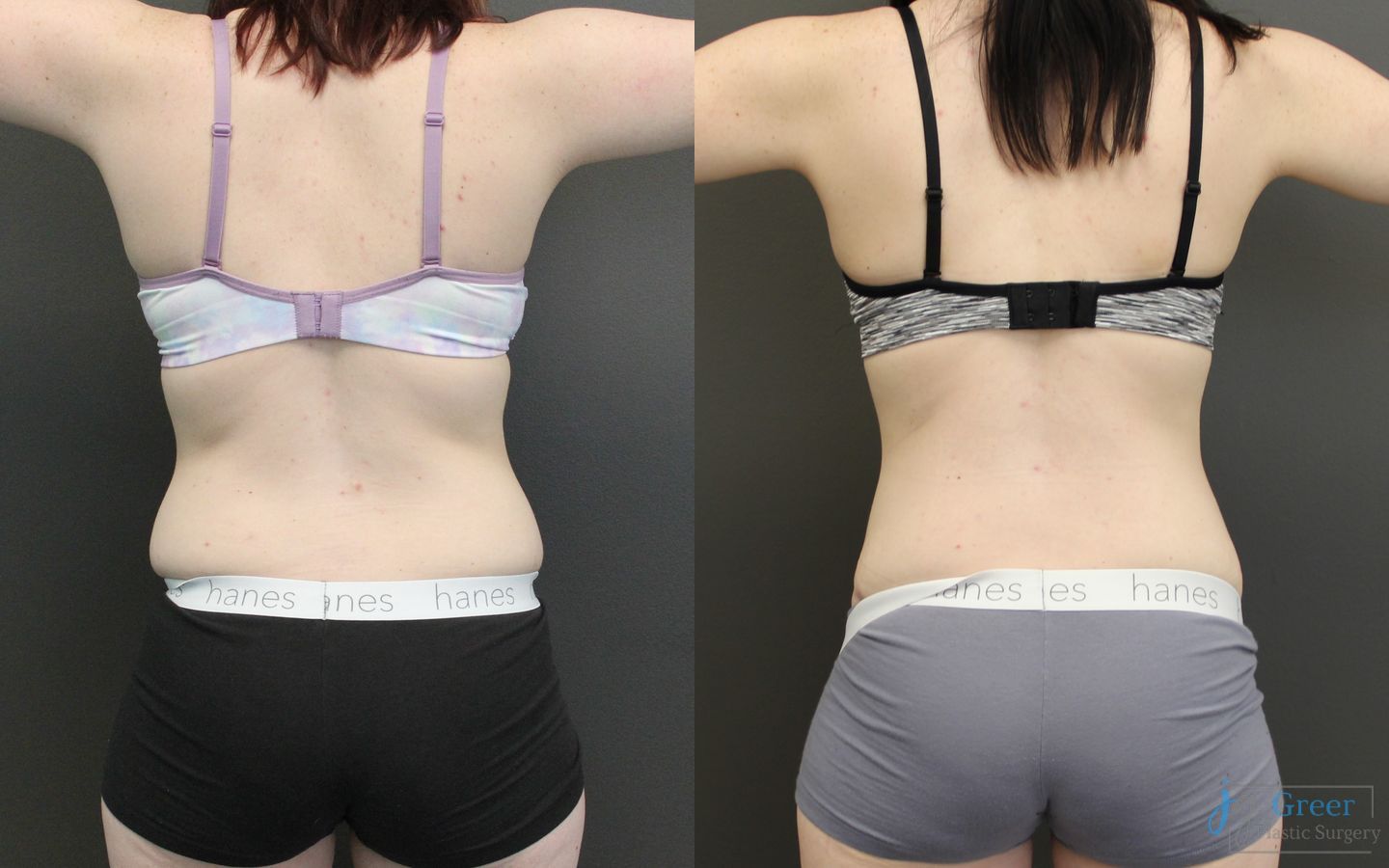 Before and after Abdominoplasty case 19842 - Angle 3