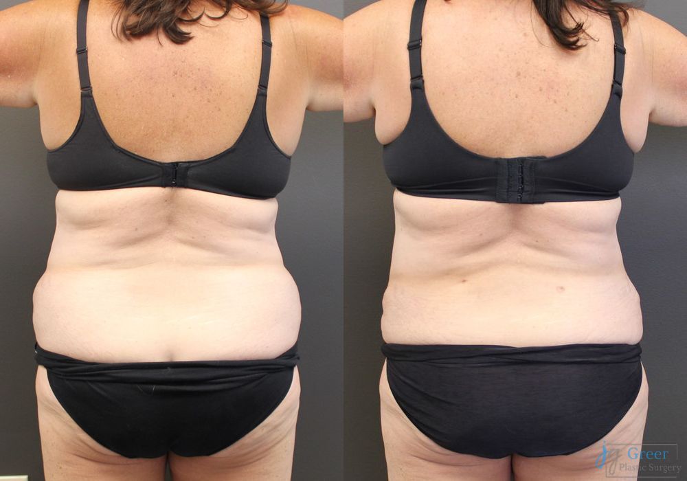 Abdominoplasty - Thumbnail 3