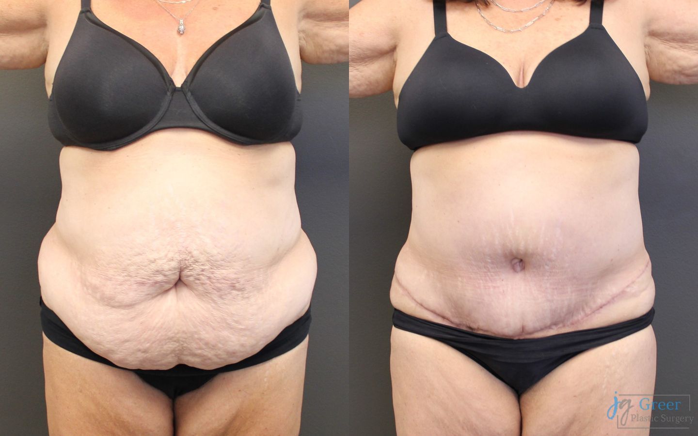 Before and after Abdominoplasty case 19840