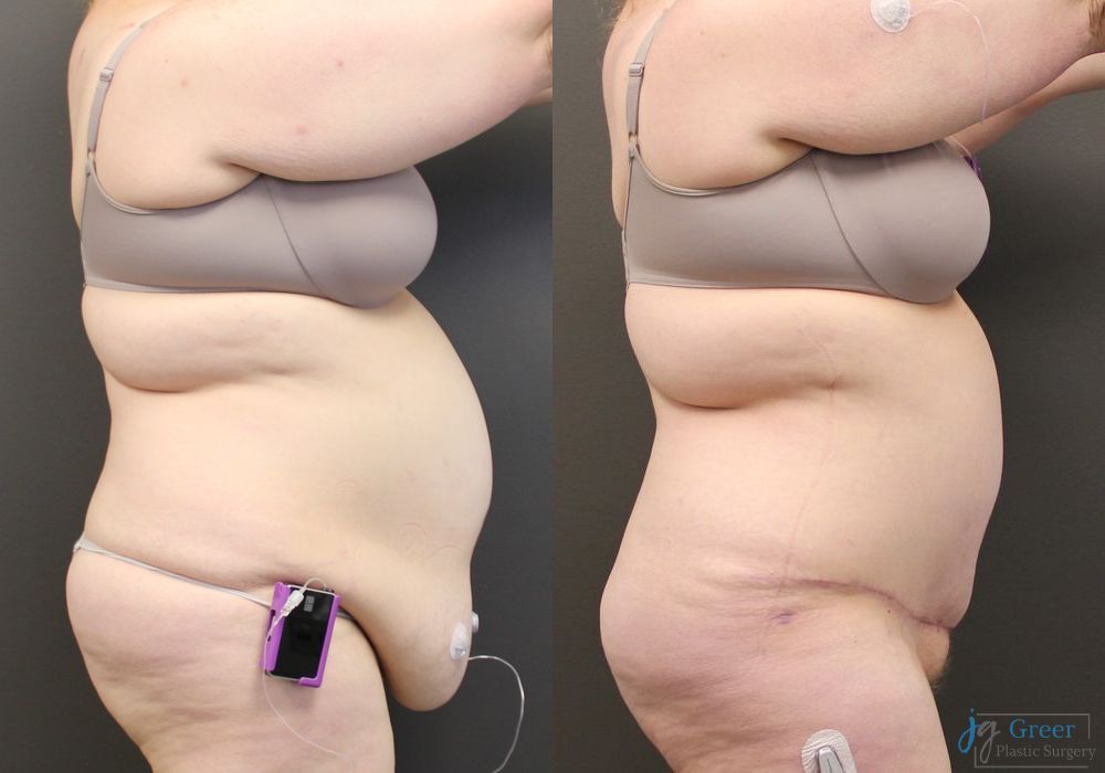 Abdominoplasty - Thumbnail 2