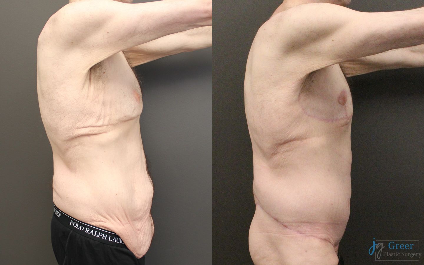 Before and after Fleur-de-Lis Abdominoplasty case 23996 - Angle 2