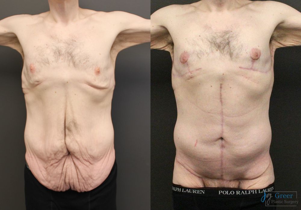 Fleur-de-Lis Abdominoplasty - Case 2658