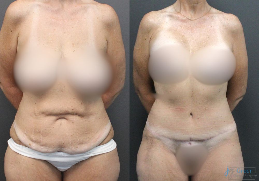 Abdominoplasty - Case 2300