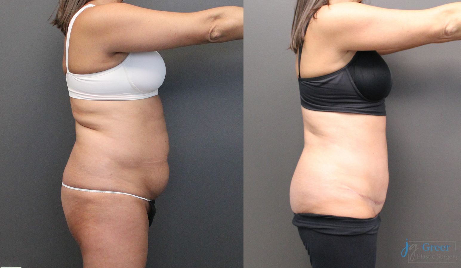 Before and after Abdominoplasty case 19845 - Angle 2