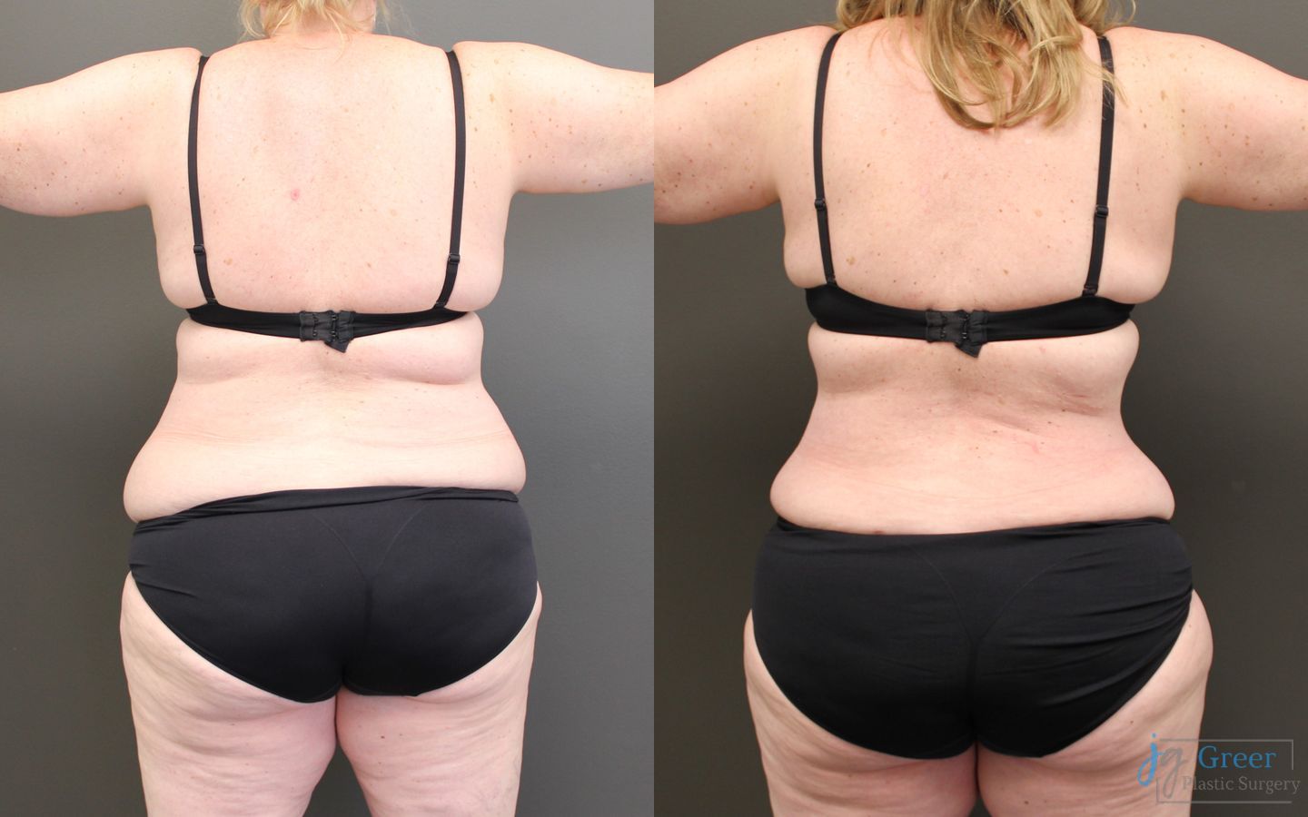 Before and after Abdominoplasty case 19839 - Angle 3