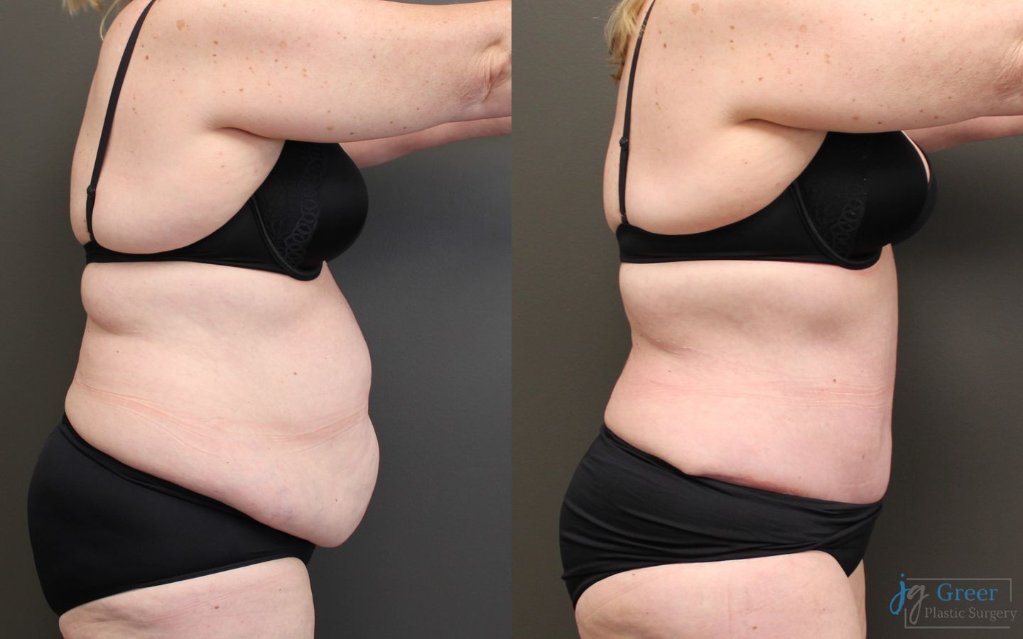 Before and after Abdominoplasty case 19839 - Angle 2