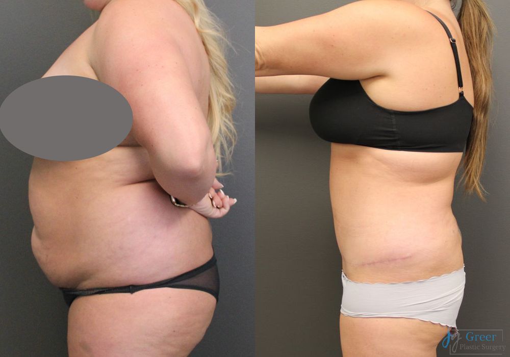 Abdominoplasty - Thumbnail 2