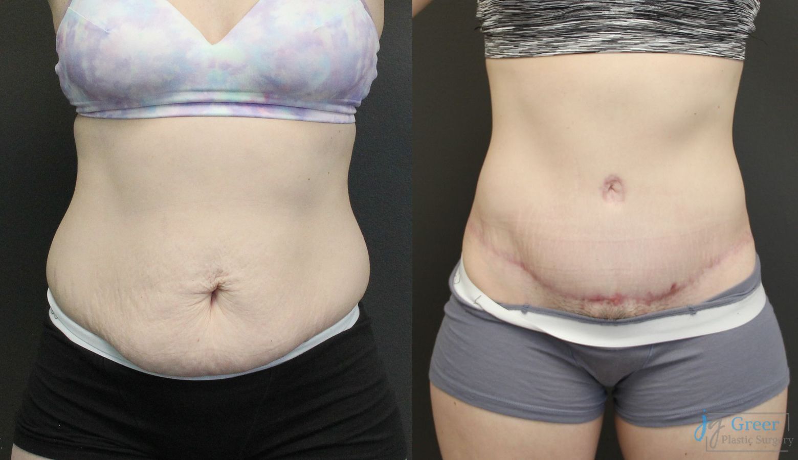 Before and after Abdominoplasty case 19842