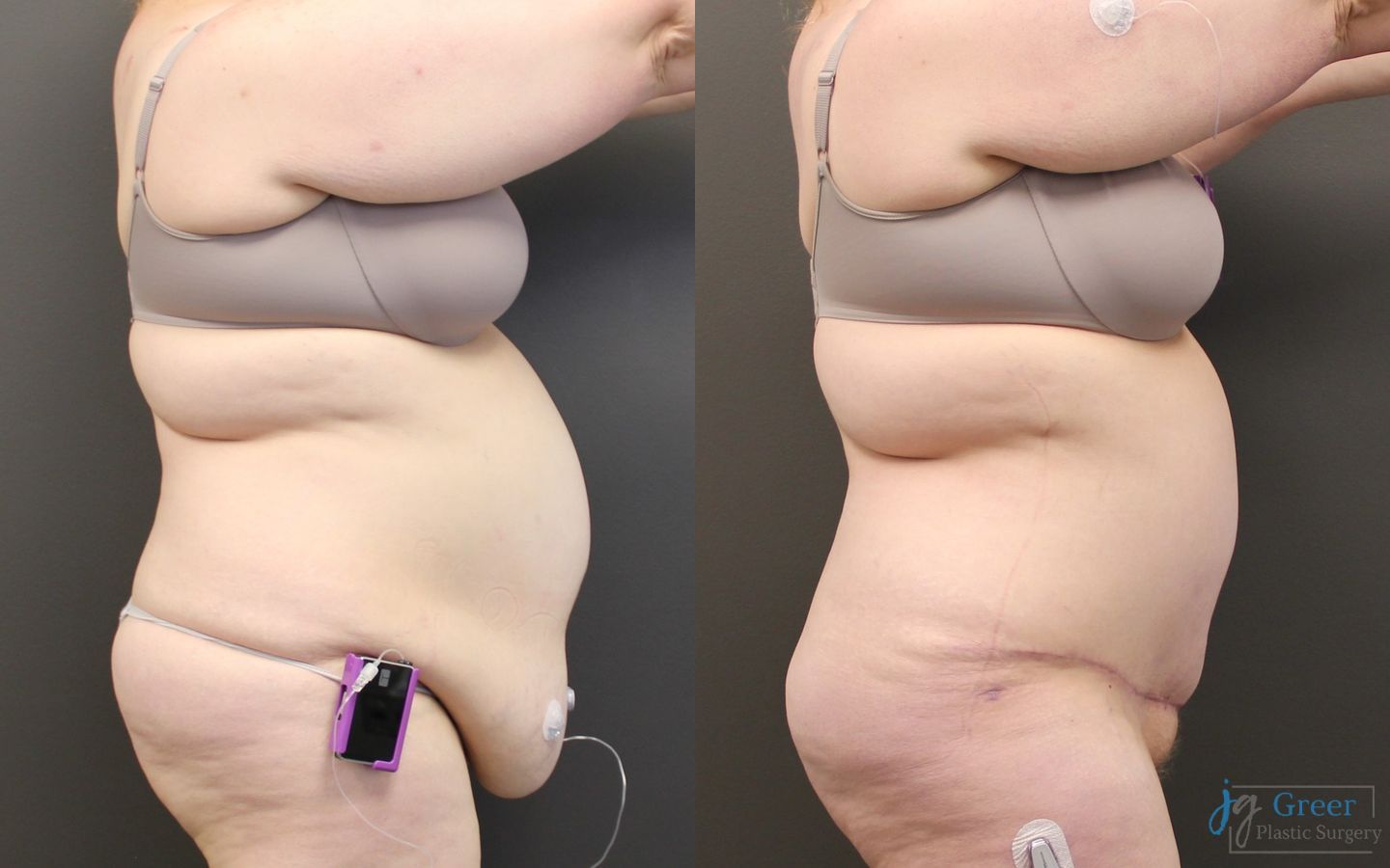 Before and after Abdominoplasty case 19841 - Angle 2