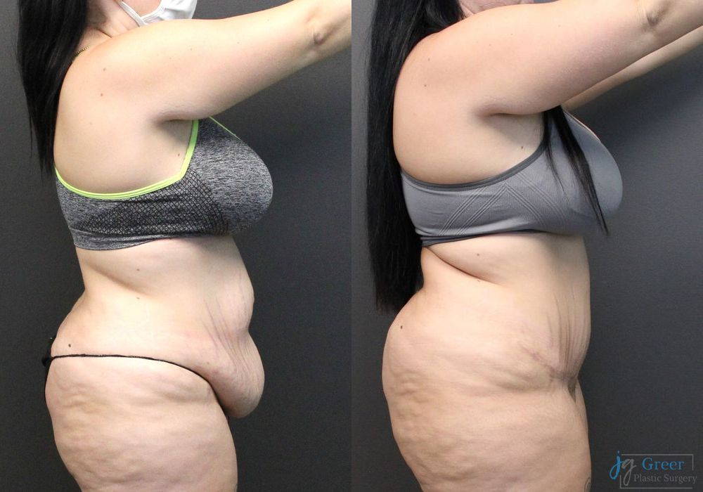 Abdominoplasty - Thumbnail 2