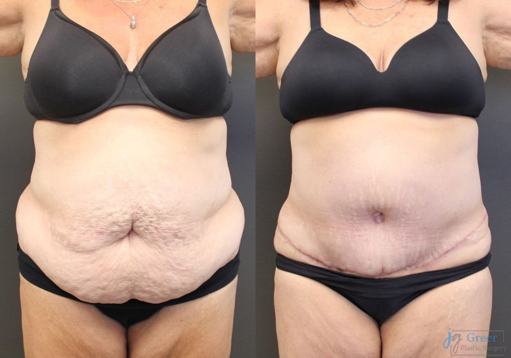 Abdominoplasty - Case 2290