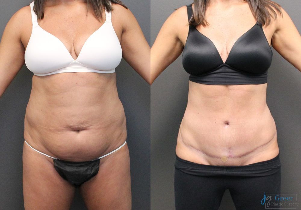 Abdominoplasty - Case 2295