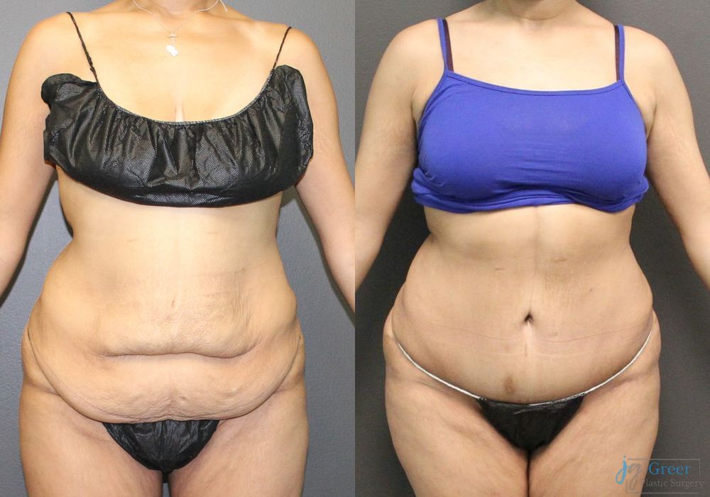 Abdominoplasty - Case 2299