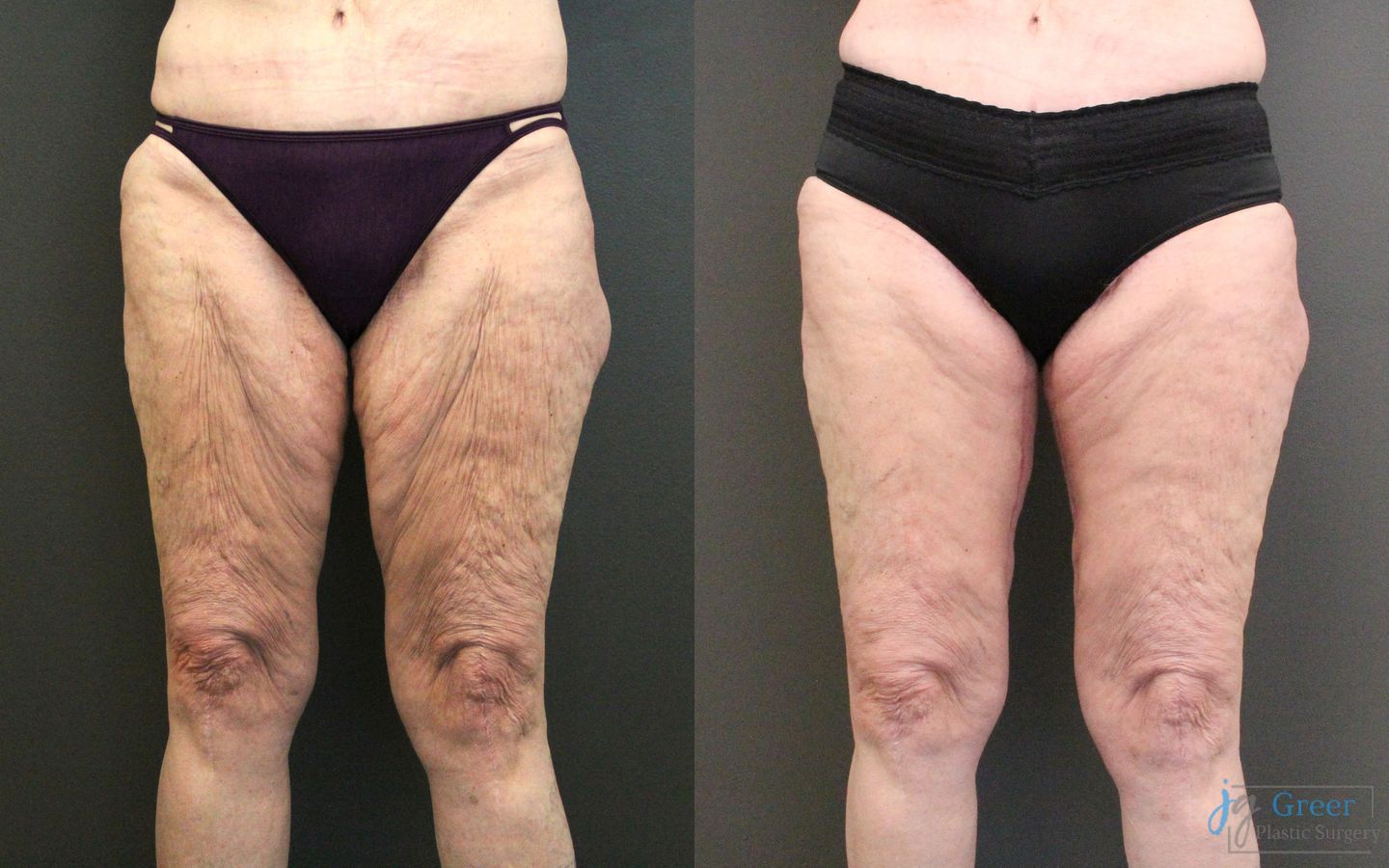 Before and after Thigh Lift case 41340 - Angle 3