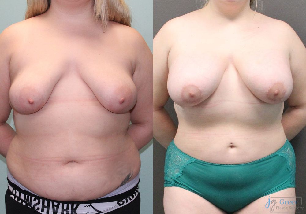 Asymmetry and tuberous breast - Case 2352