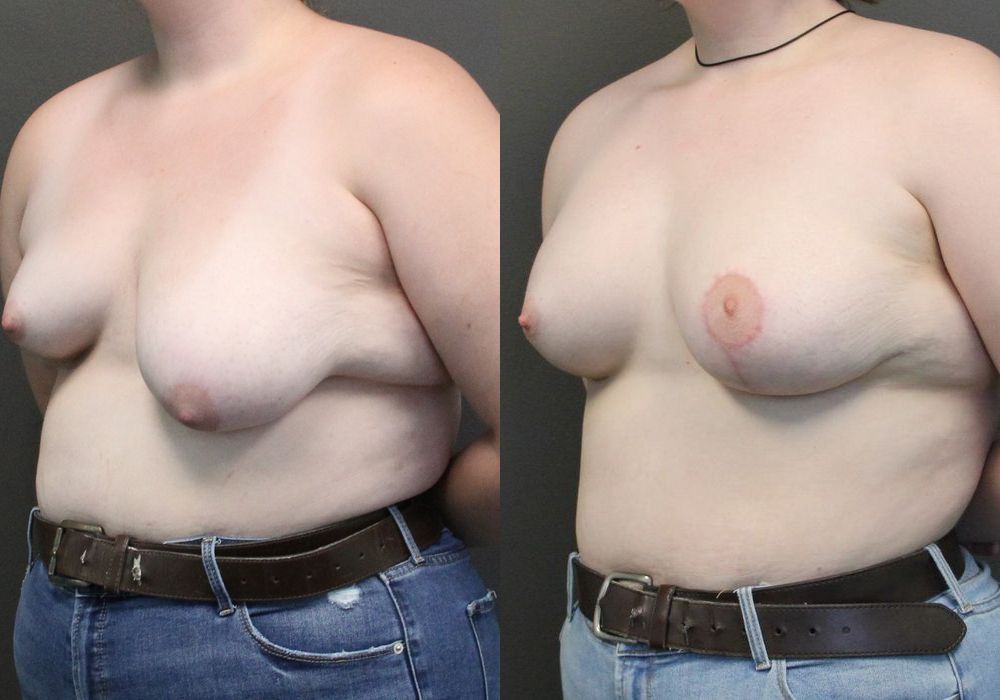 Asymmetry and tuberous breast - Thumbnail 2