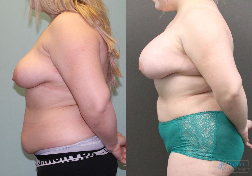 Before and after Asymmetry and tuberous breast case 19810 - Angle 2