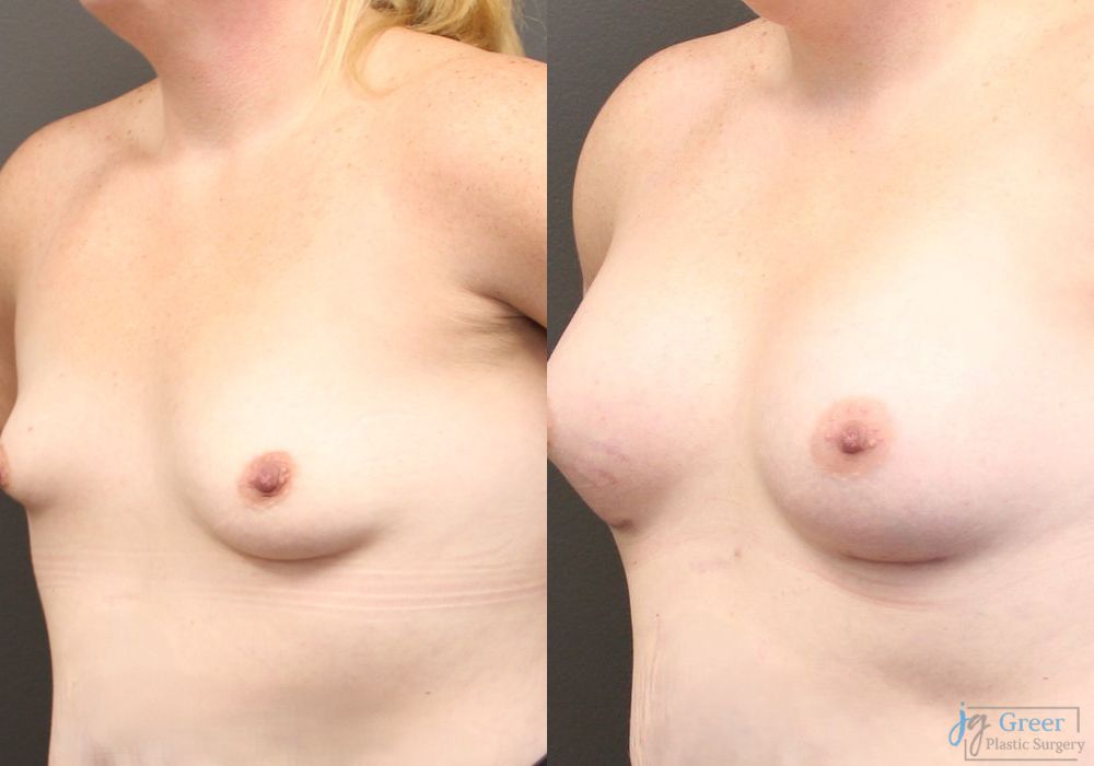 Asymmetry and tuberous breast - Thumbnail 2