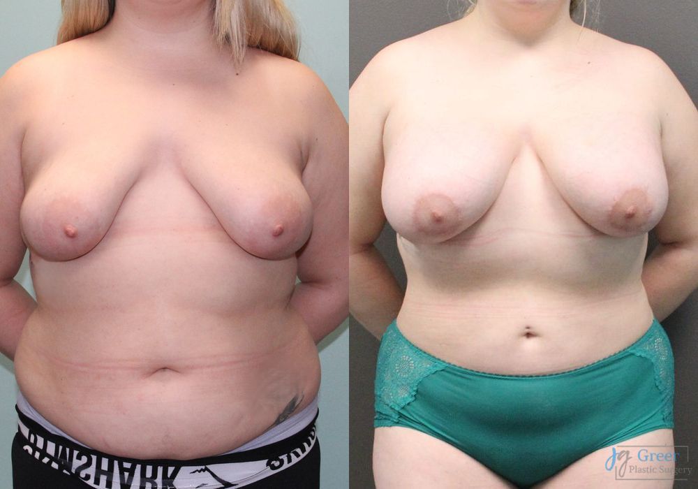 Before and after Asymmetry and tuberous breast case 19810