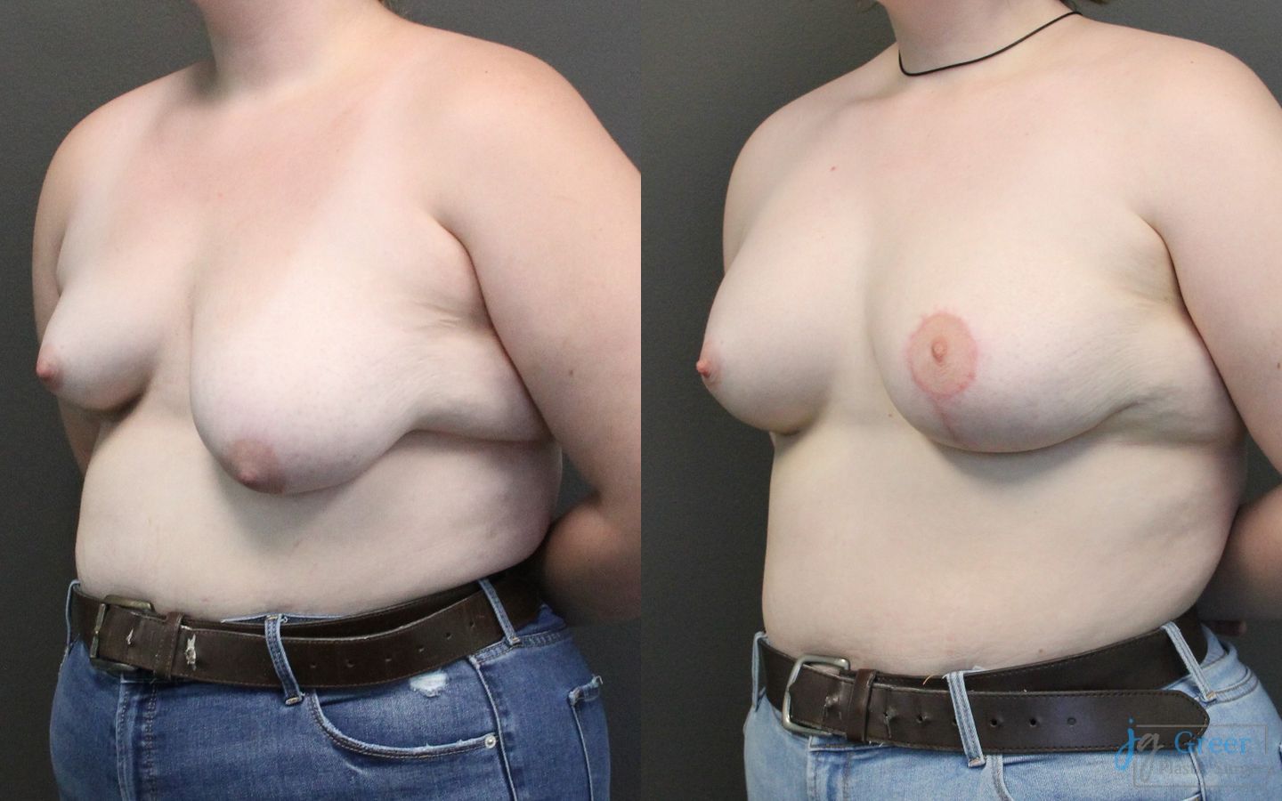 Before and after Asymmetry and tuberous breast case 19809 - Angle 2