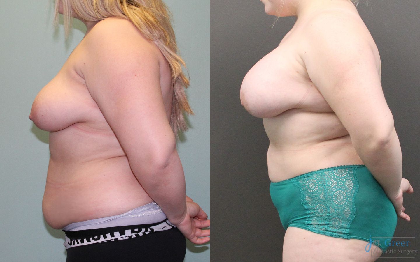 Before and after Liposuction case 19810 - Angle 2
