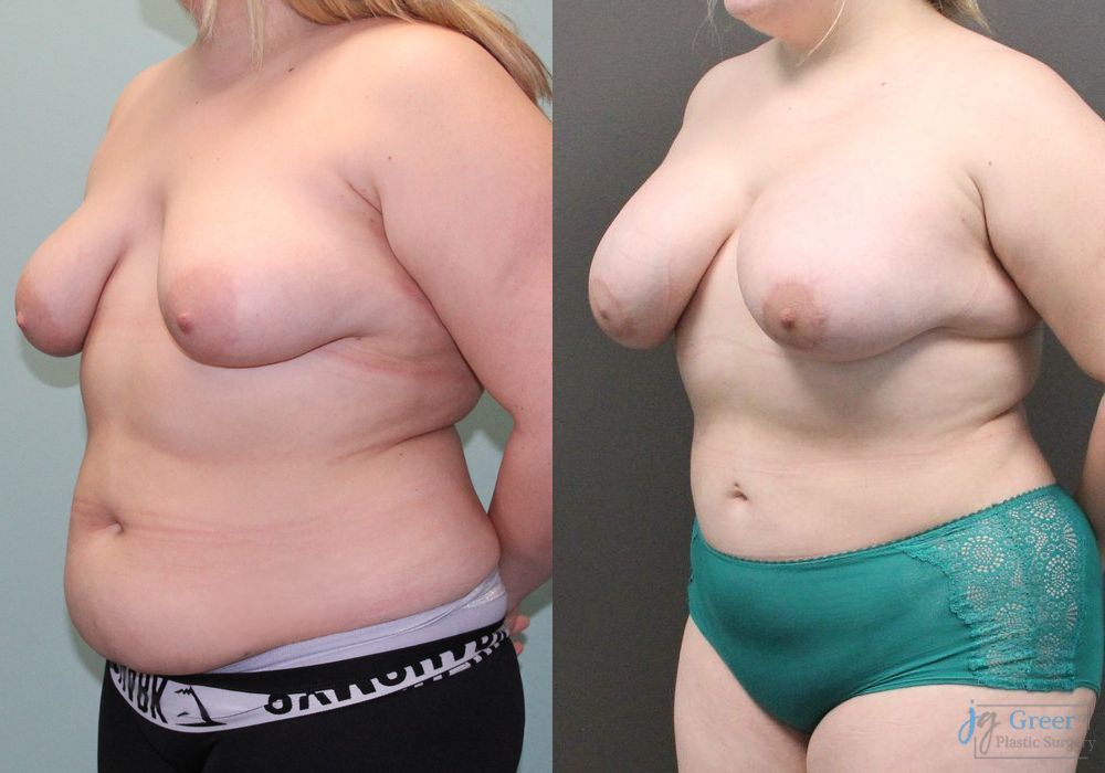 Before and after Asymmetry and tuberous breast case 19810 - Angle 3