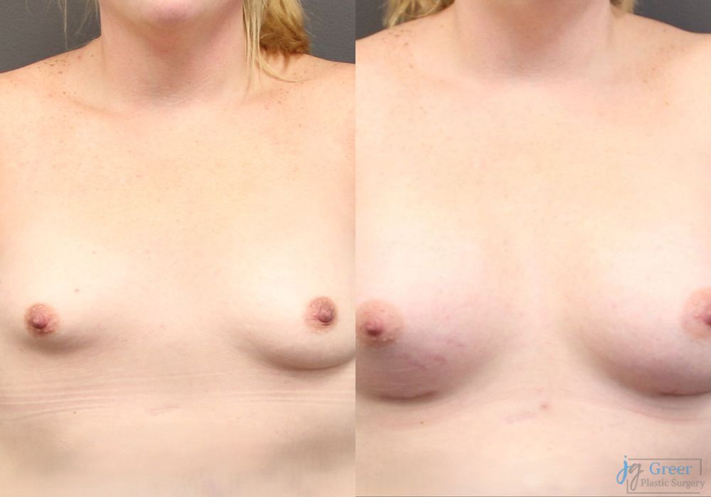 Asymmetry and tuberous breast - Case 2350