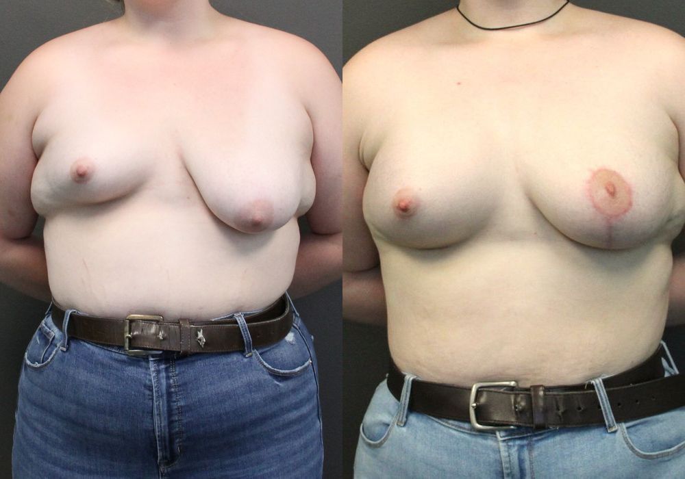 Asymmetry and tuberous breast - Case 2351