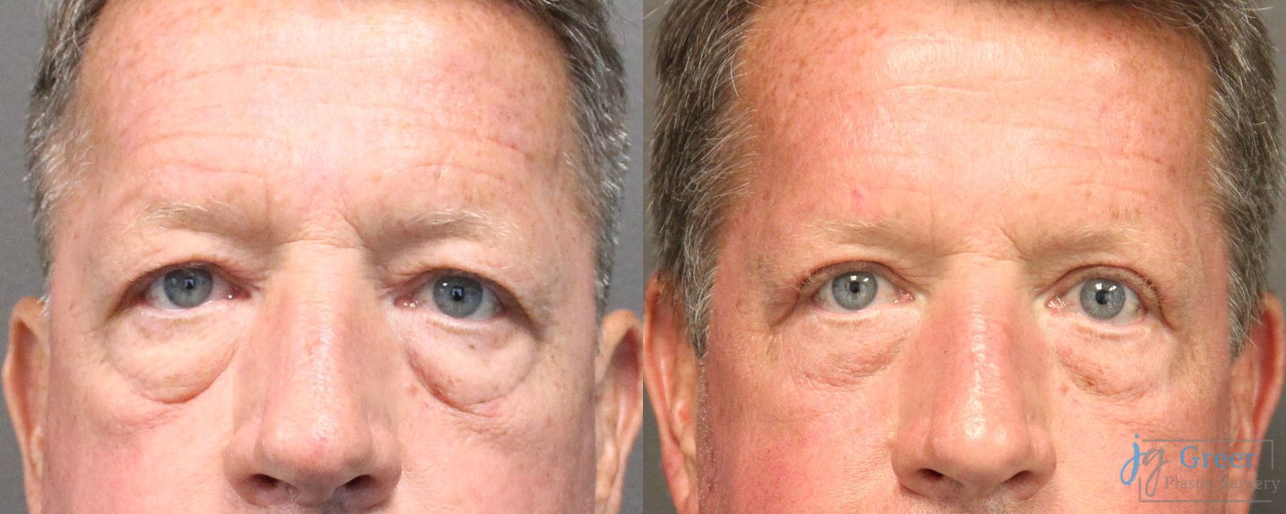 Before and after Blepharoplasty case 19885