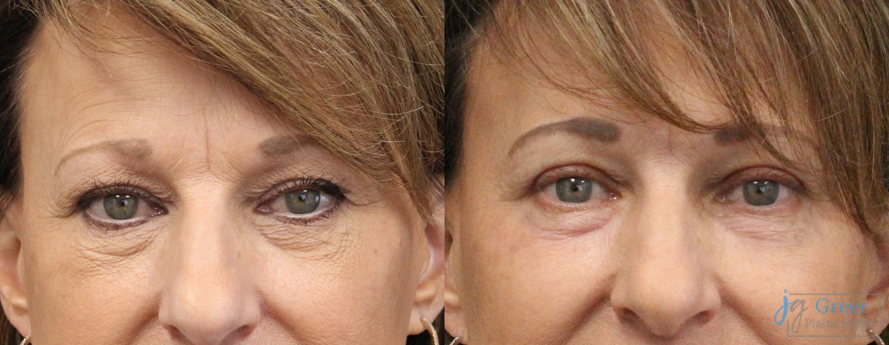 Before and after Blepharoplasty case 37373