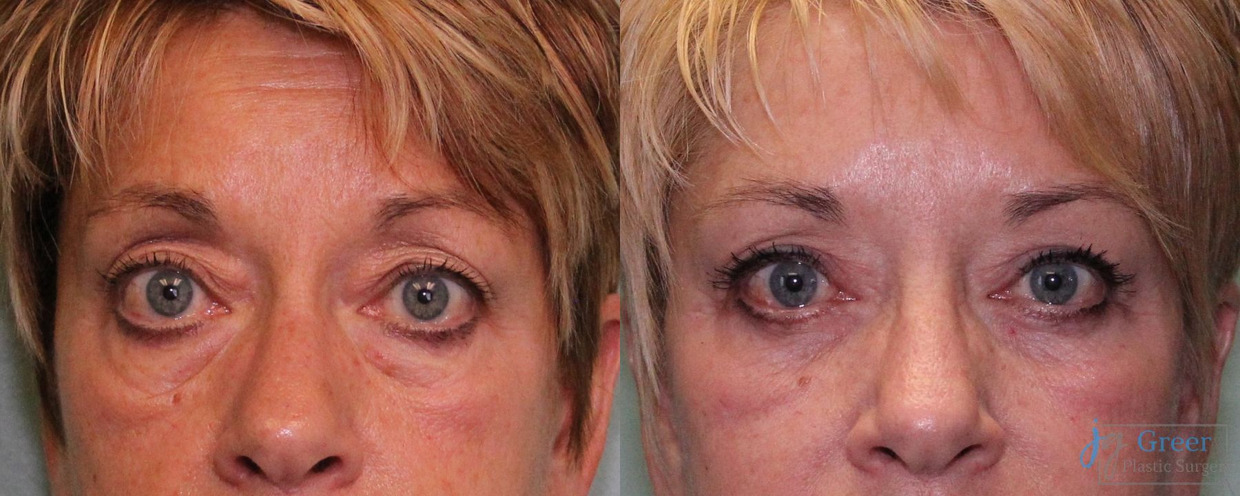 Before and after Blepharoplasty case 19888