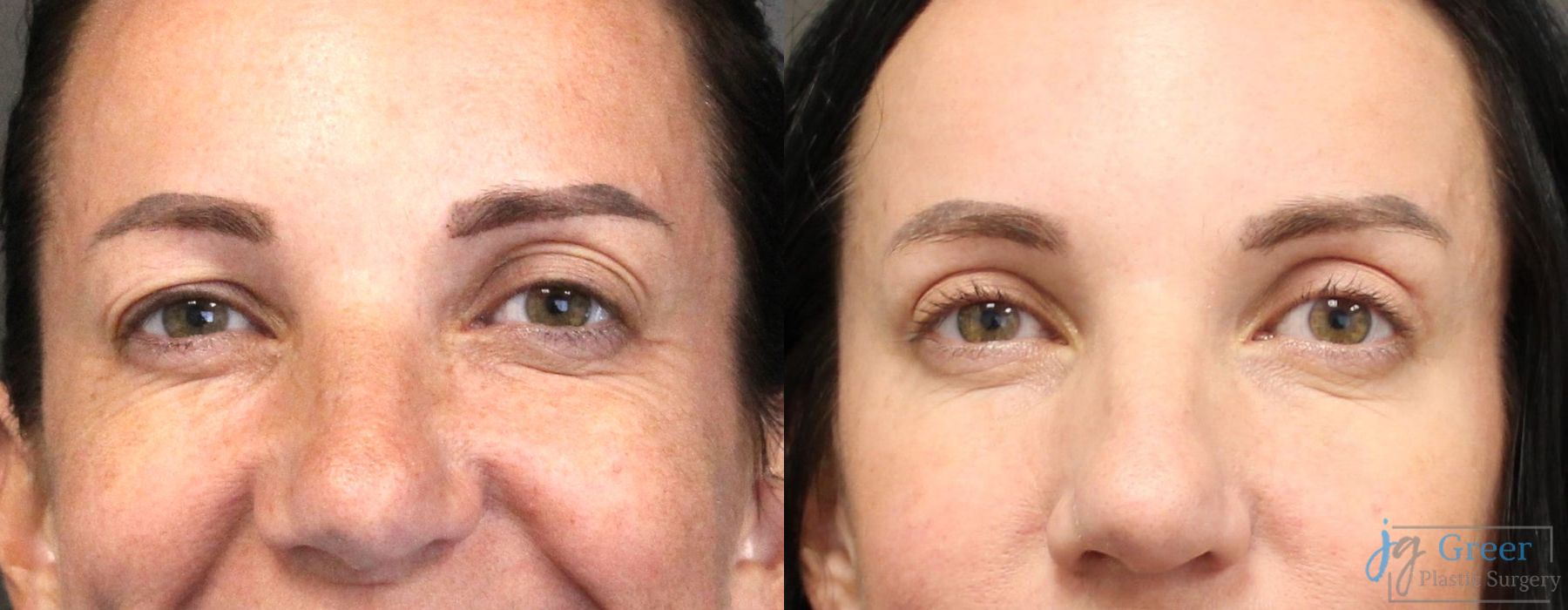 Blepharoplasty - Case 2394