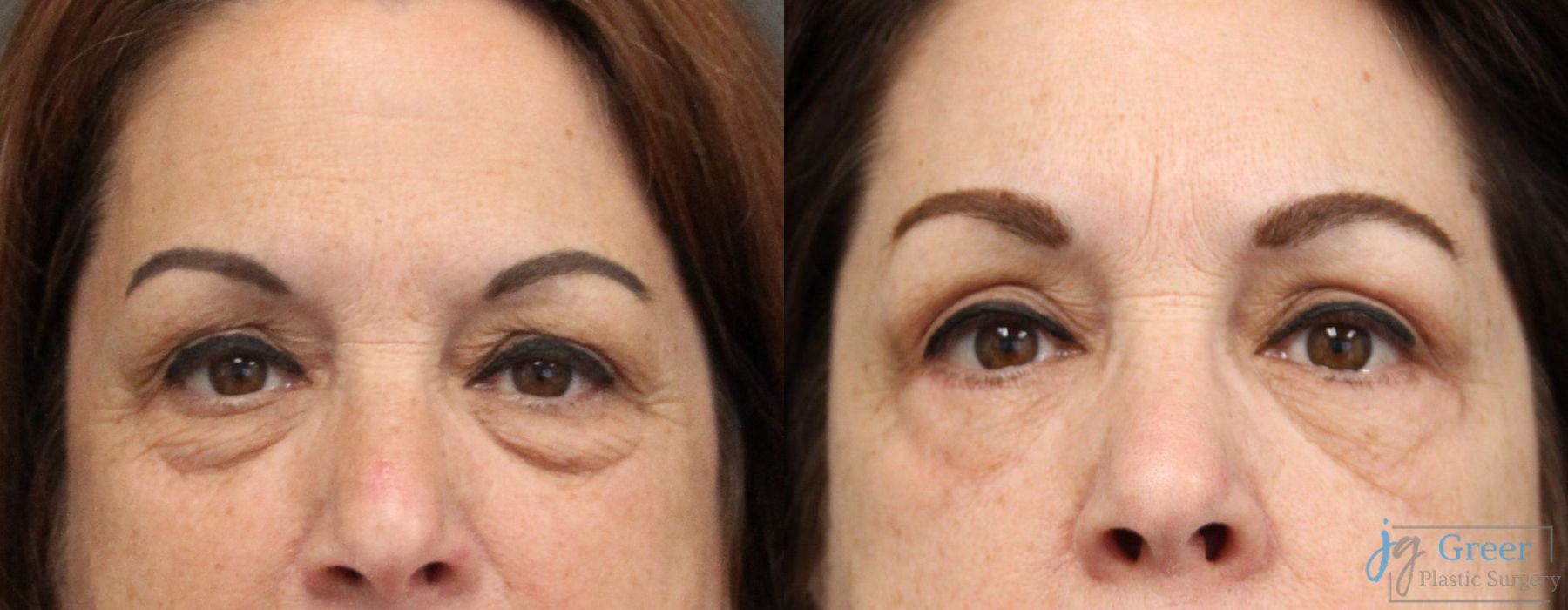 Blepharoplasty - Case 2397