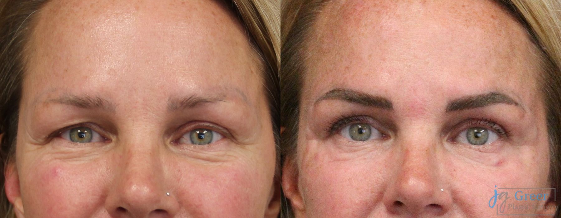 Blepharoplasty - Case 2406