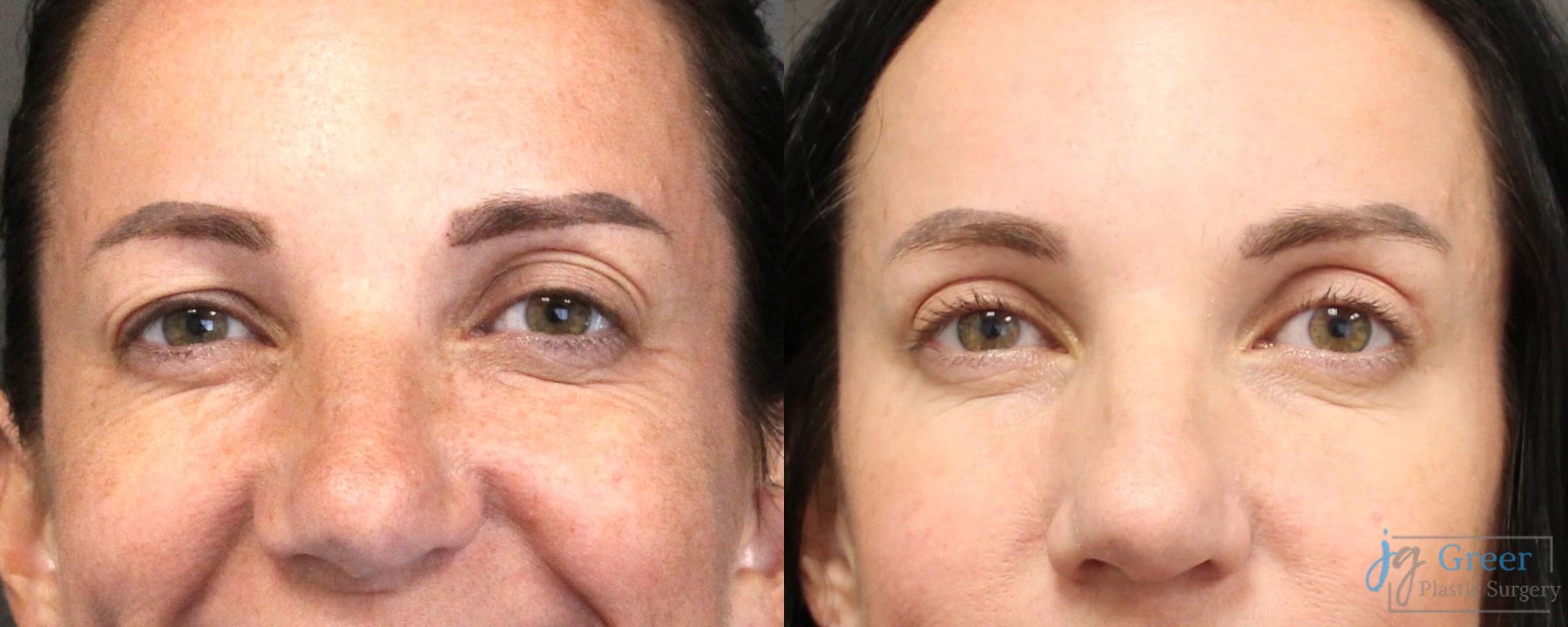 Before and after Blepharoplasty case 19883