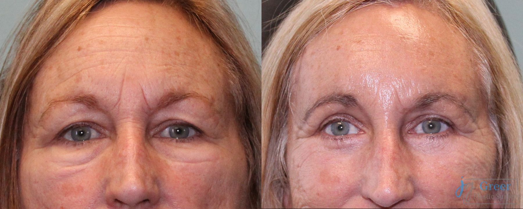 Before and after Brow Lift case 19891