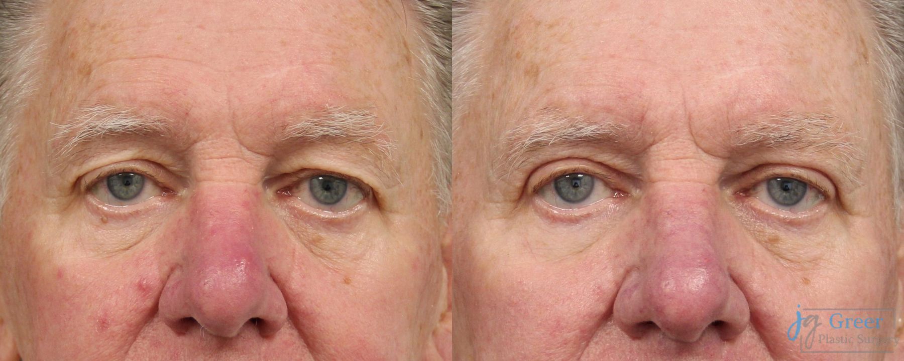 Before and after Blepharoplasty case 19889