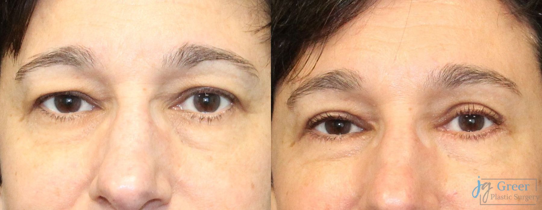 Before and after Blepharoplasty case 19890
