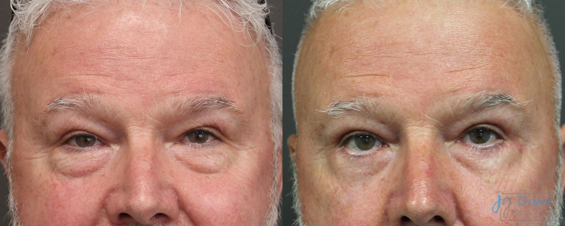 Before and after Blepharoplasty case 19882