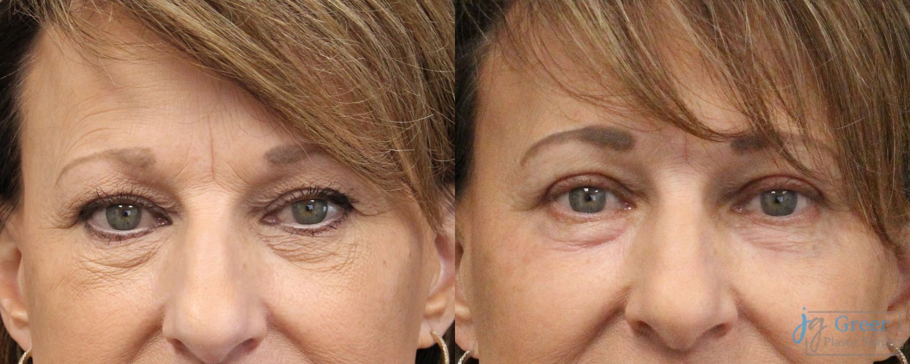 Before and after Laser Skin Resurfacing case 37373